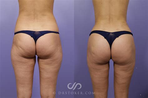Fat Grafting Buttocks