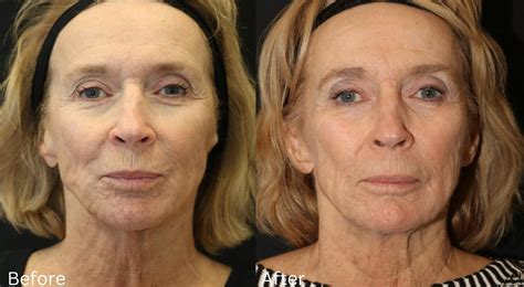 Skin Tightening RF | Cosmetic Surgery | Santa Rosa Skin Tightening RF