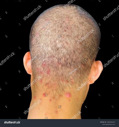 Closeup Back Shaved Head Showing Multiple Stock Photo 2502401015 ...