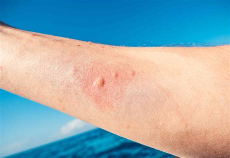 How Do Box Jellyfish Stings Work at Michelle Diaz blog