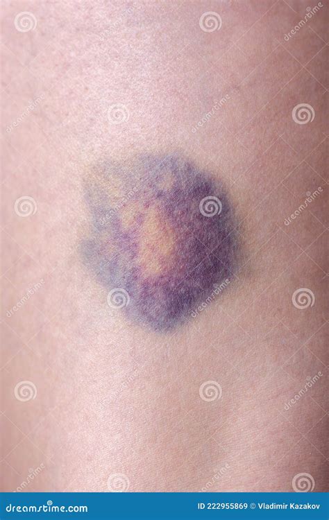 Itchy Rash Bruises Legs at Charles Banks blog