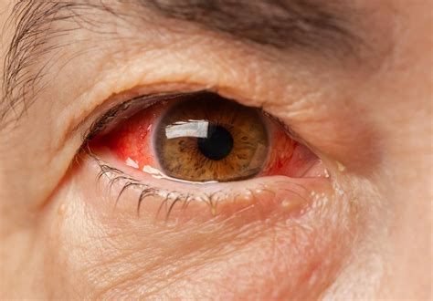 Subconjunctival Hemorrhage: Symptoms, Causes, Treatment