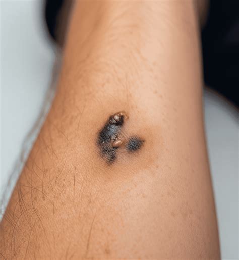 Zoon’s Balanitis: Symptoms, Causes & Laser Treatment