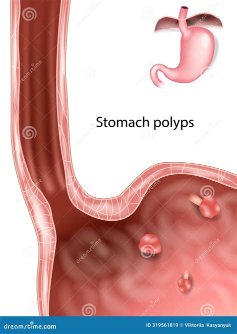 Types Of Gastric Polyps