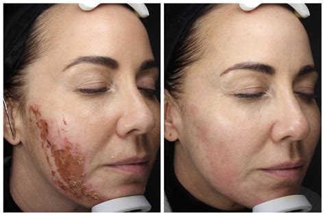 How To Treat Skin After Chemical Peel Burn at Paige Cremean blog