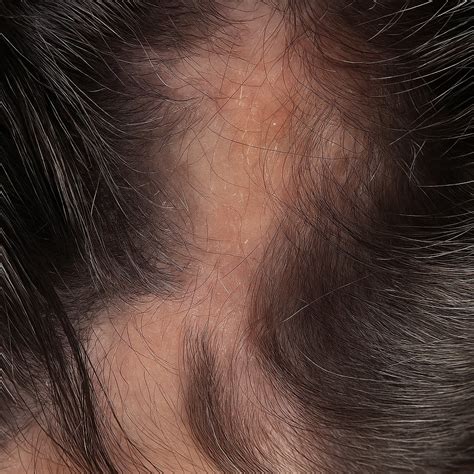 Hongos Cuero Cabelludo: Síntomas y Tratamientos Efectivos