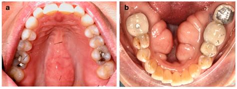 The Prevalence of Maxillary and Mandibular Exostosis in the Mississippi Population: A ...