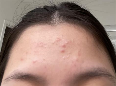Help for bumps on forehead : r/SkincareAddicts
