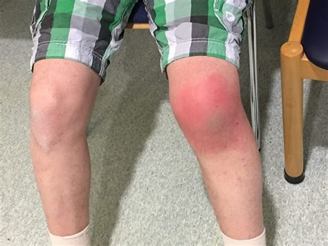 Septic Bursitis Knee Treatment at Lara Caley blog