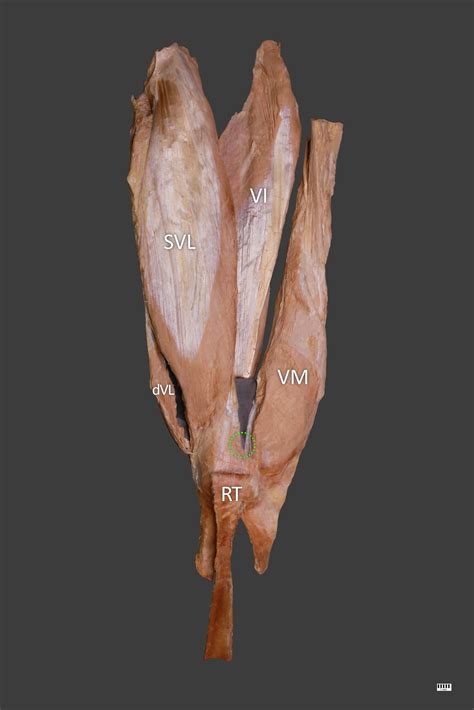 A new look at quadriceps tendon – Is it really composed of three layers? - The Knee