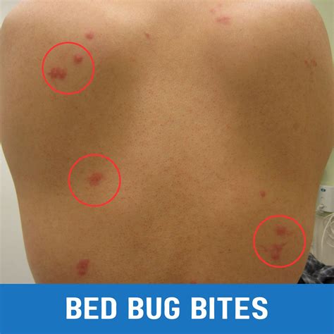 How to Prevent Bed Bug Bites While Sleeping : A Step by Step Guide