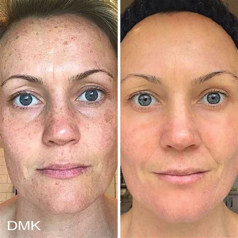 DMK Enzyme Therapy: Hollywood’s Skincare Secret
