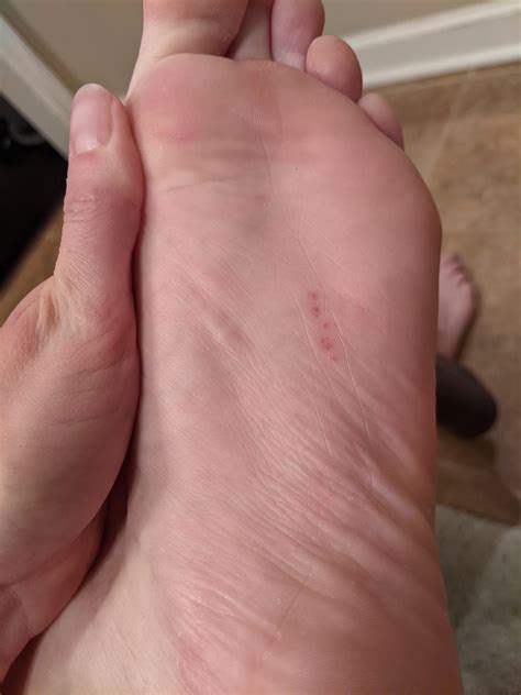 Little Itchy Bumps On Bottom Of Foot Outlet | emergencydentistry.com