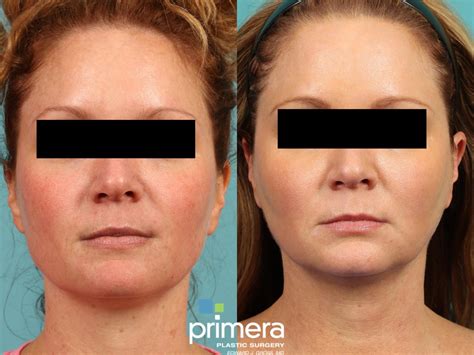 Pulsed Dye Laser (Candela V-Beam) Before and After Pictures Case 869 | Orlando, Winter Park ...
