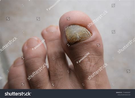 Young Man Barefoot Fingers Onycho Mycosis Stock Photo 1734896087 ...