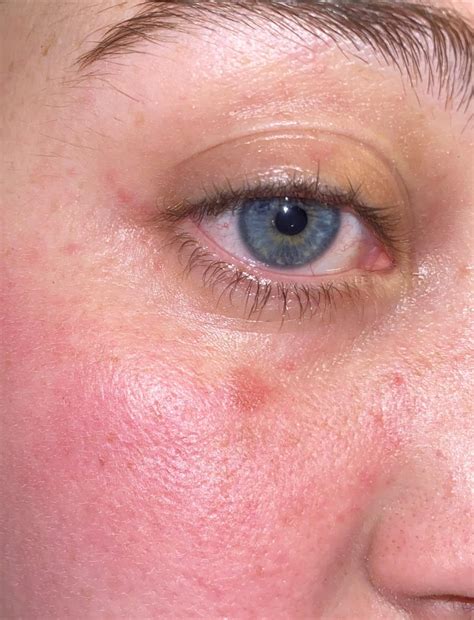 Red dry(ish) bumpy dot on face : r/skin