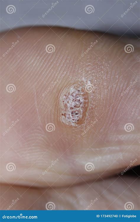 Plantar Wart Close Up On The Bottom Of A Female Foot Heel Caused By The Human Papillomavirus, Or ...