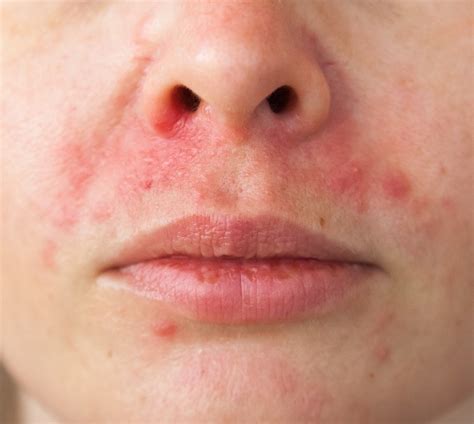 Perioral Dermatitis Vs Acne