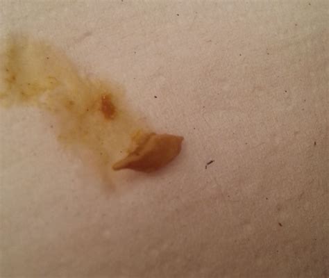 Liver Flukes In Stool