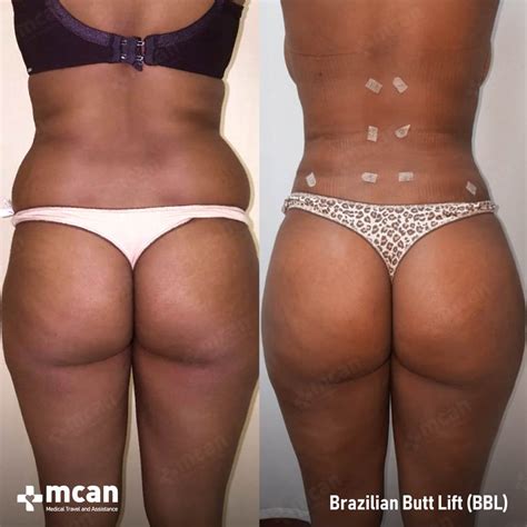 Brazilian Butt Lift (BBL) in Turkey | MCAN Health