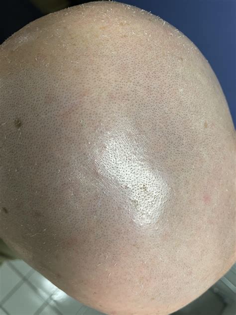 How to stop itchy, ingrown hairs a few weeks after epilating? : r/HairRemoval
