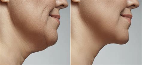 Banish Sagging: Top Filler for Jowls Treatment | Foxy Fillers