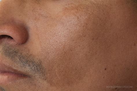 Tratamiento del melasma - Didac Barco