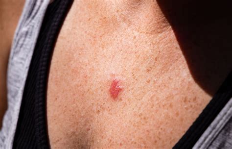 Squamous Cell Carcinoma Treatment – Chatham Skin Clinic