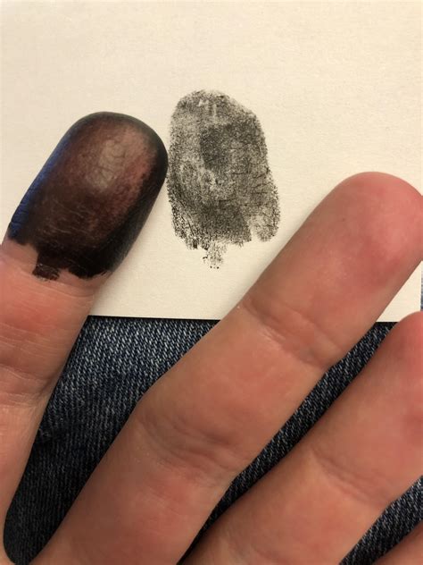 I was born without finger or toe prints. – The Almanac