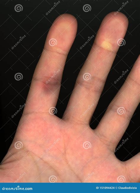 Bursted Capillary in Hand Finger Stock Photo - Image of hospital, minor ...