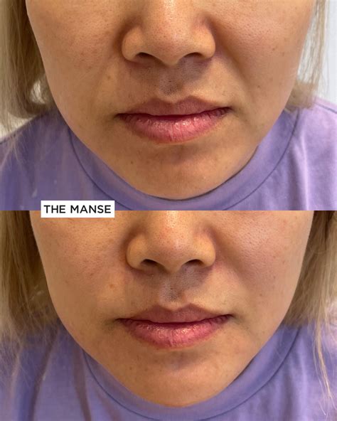 Juvederm Nasolabial Folds Before And After Nasolabial Folds Before And