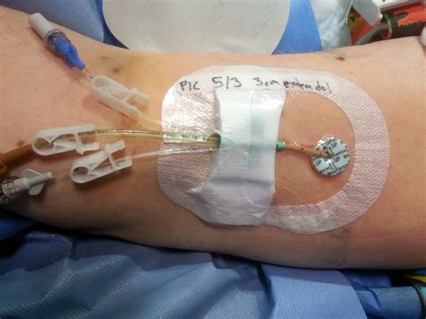 Studio sull'uso più restrittivo dei PICC - Nurse Times