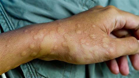 Hives: Symptoms Causes and Treatment