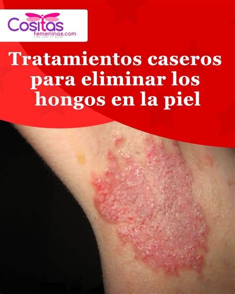 Por Qué Salen Hongos En La Piel – PEMPAW