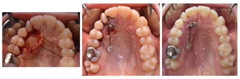 Treatment of Palatally Displaced Canines Using Miniscrews for Direct or ...