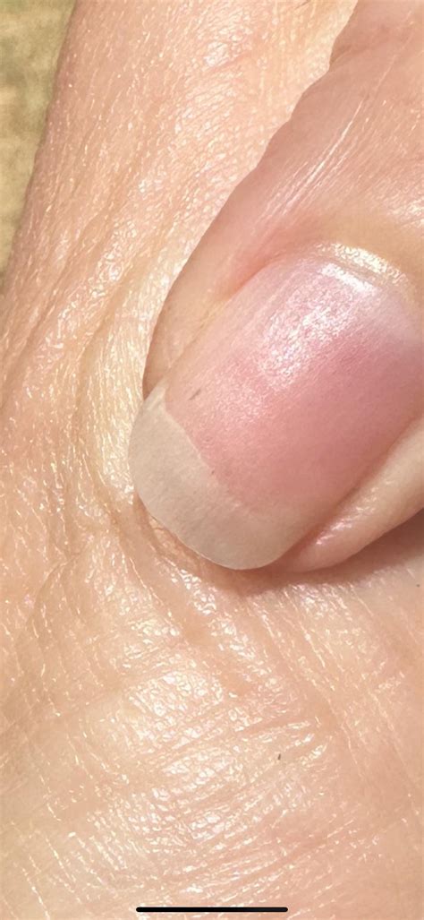 Nail splinter hemorrhages : r/Raynauds