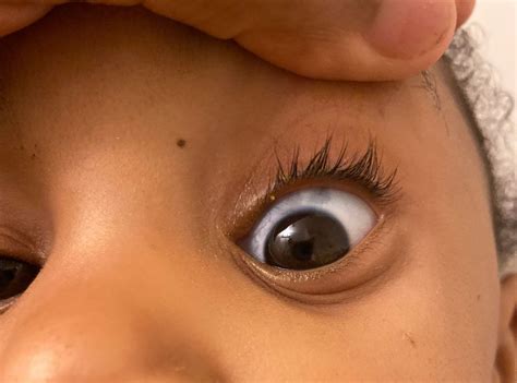 Black spots on eyes?? | BabyCenter