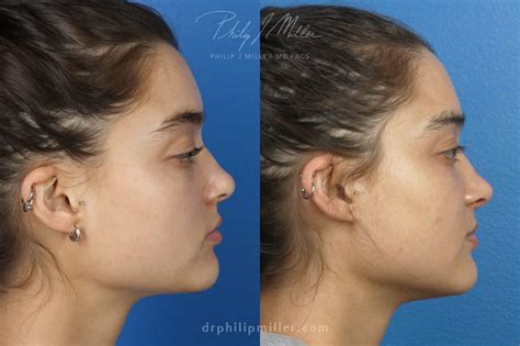 Rhinoplasty Swelling Stages: What to Expect | Philip J. Miller, MD ...