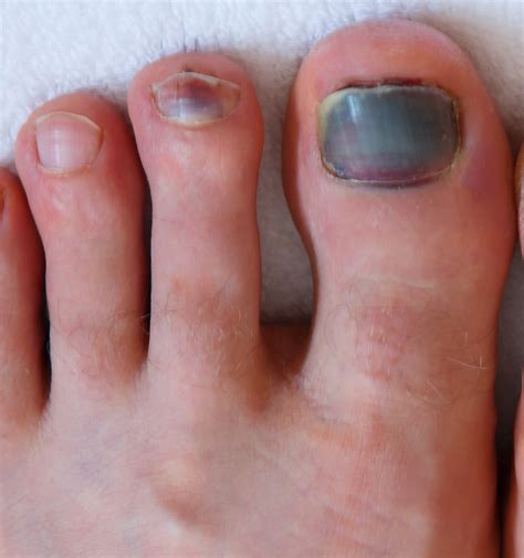 Bruised Toenail 7 Best Causes & Treatments | Balance Foot