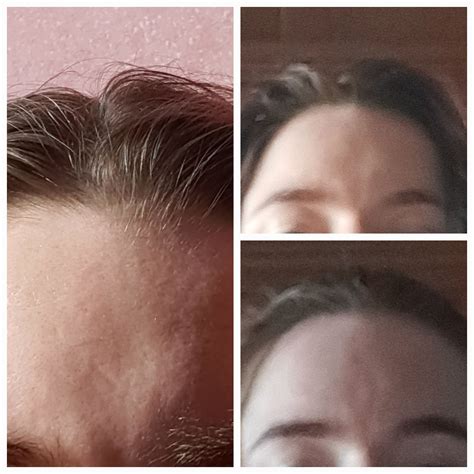 Does this look like en coup de sabre? : r/scleroderma