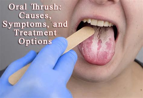 Oral Thrush: Causes, Symptoms, and Treatment Options