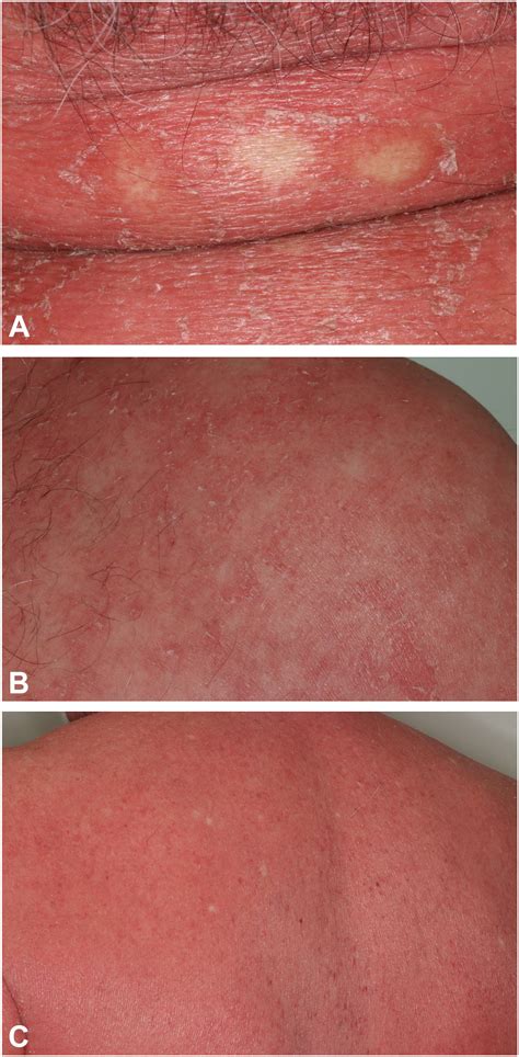 Pityriasis rubra pilaris - Journal of the American Academy of Dermatology