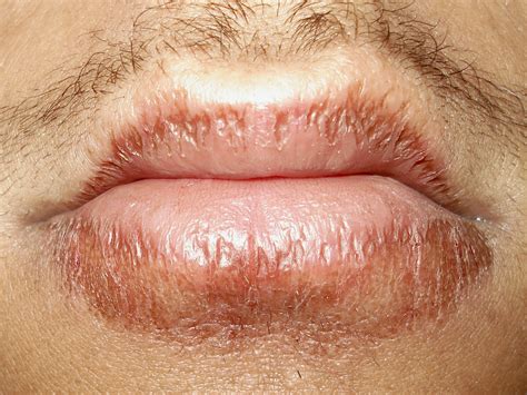 Lip Licking Dermatitis Treatment at Juan Pate blog