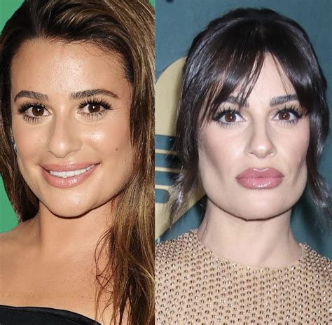 Buccal Fat Removal Kardashians at Terrance Olson blog