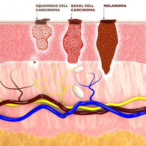 Malignant Melanoma Stage 4