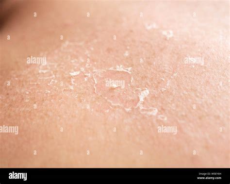 Skin Peeling After Sunburn
