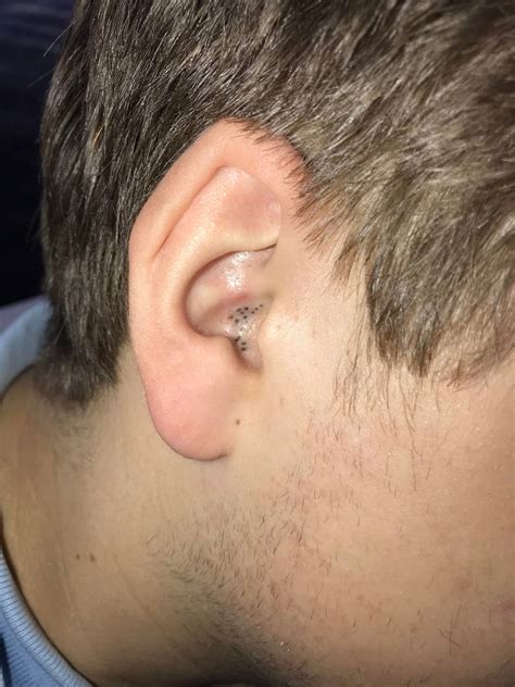 Blackhead Inside Ear