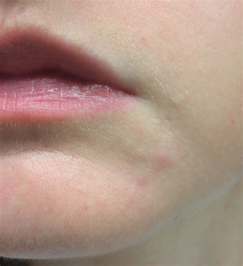 Why is perioral dermatitis often mistaken for rosacea? – what is perioral dermatitis | XAKY