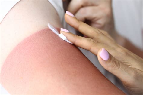 First-Degree Burn Treatment and Care - CHC Solutions