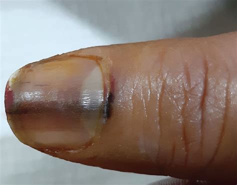 Melanoma Nail Symptoms